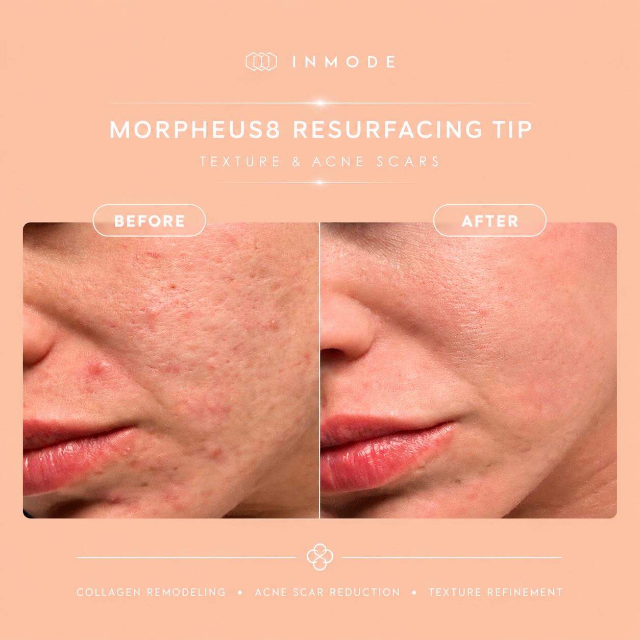 MORPHEUS8 RESURFACING TIP - ADVANCED ACNE SCAR & TEXTURE CORRECTION

Acne scars, enlarged pores, and uneven skin texture are often the result of chronic inflammation and collagen disruption within the skin. The Morpheus8 Resurfacing Tip is specifically designed to target the superficial dermal layers where many textural concerns originate. By combining fractional radiofrequency (RF) energy with advanced resurfacing technology, it stimulates neocollagenesis and elastin production while promoting epidermal renewal.

Benefits of Morpheus8 Resurfacing Tip include:

✔ Improvement of acne scars and post-inflammatory skin irregularities
✔ Refinement of skin texture and smoother skin surface
✔ Reduction in enlarged pores
✔ Enhanced collagen remodeling and dermal regeneration
✔ Improvement in skin tone uniformity
✔ Softening of superficial textural imperfections
✔ Increased skin firmness and overall skin quality
✔ Minimal downtime compared to more aggressive resurfacing procedures

This treatment is ideal for patients seeking a clinically advanced solution for acne scarring, rough texture, enlarged pores, and overall skin rejuvenation without the extended recovery associated with traditional ablative treatments.

🧬Clinical study image. Individual results may vary.

📍 Book your consultation today and discover whether Morpheus8 Resurfacing Tip is the right treatment for your skin concerns.

📩 DM us to learn more or secure your appointment.

#Morpheus8 #AcneScars #SkinResurfacing #TextureCorrection #MelbourneSkinClinic