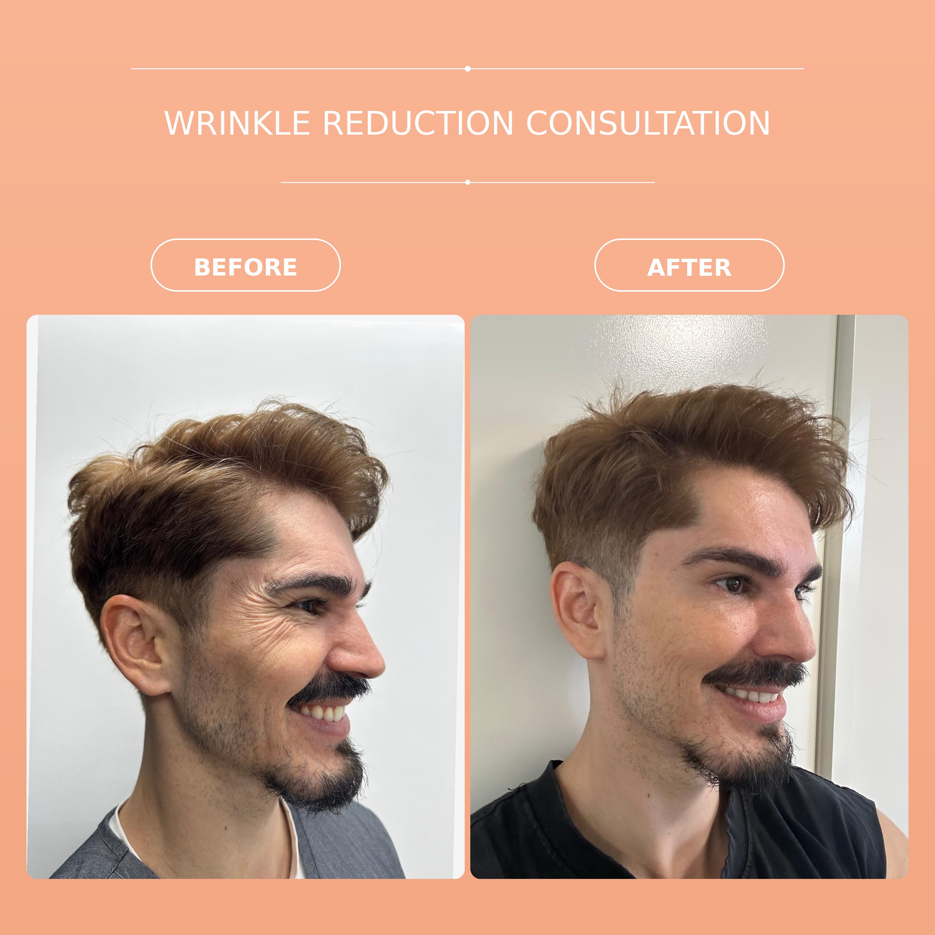 Smoother expression.
Refreshed appearance.
Still completely you. ✨
We offer Wrinkle Reduction Consultations at Hi Care Skin Clinic, personalised approach designed to assess your facial movement, areas of concern and aesthetic goals before creating a treatment plan tailored specifically to you.
A Registered Cosmetic Nurse will provide a comprehensive clinical assessment, considering your facial anatomy, expressions and desired outcome to recommend the most appropriate approach while prioritising safety, precision and subtle, natural-looking results.
Whether you’re looking to soften the appearance of crow’s feet, forehead lines, frown lines and glabellar region our focus is always on achieving a natural, balanced and refreshed result.
Book your Wrinkle Reduction Consultation today. 🤍
📍 Melbourne CBD
📩 DM us or book online to secure your appointment.
#WrinkleReductionMelbourne #MelbourneSkinClinic #MelbourneAesthetics #AntiWrinkleMelbourne #HiCareSkinClinic